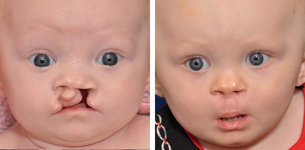 Bilateral Cleft Palate Repair Surgery