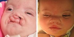 Bilateral Cleft Lip and Palate