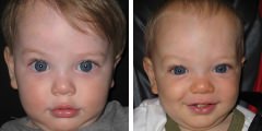 Craniosynostosis Surgery Before & After Photos Beverly Hills