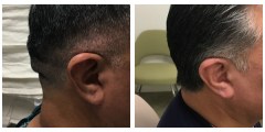 Cranioplasty