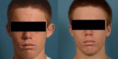Ear Deformities - Otoplasty