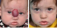 Hemangioma Reconstruction Surgery Before & After Photos Beverly Hill
