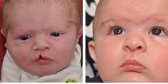 Unilateral Cleft Lip and Palate