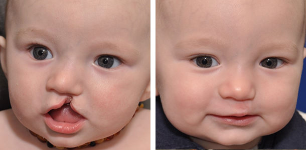 Cleft Palate Repair Surgery