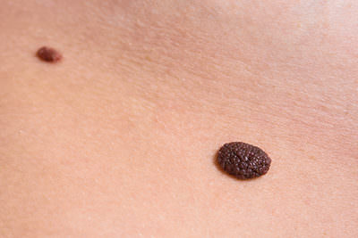 Pigmented Congenital Nevus Beverly Hills